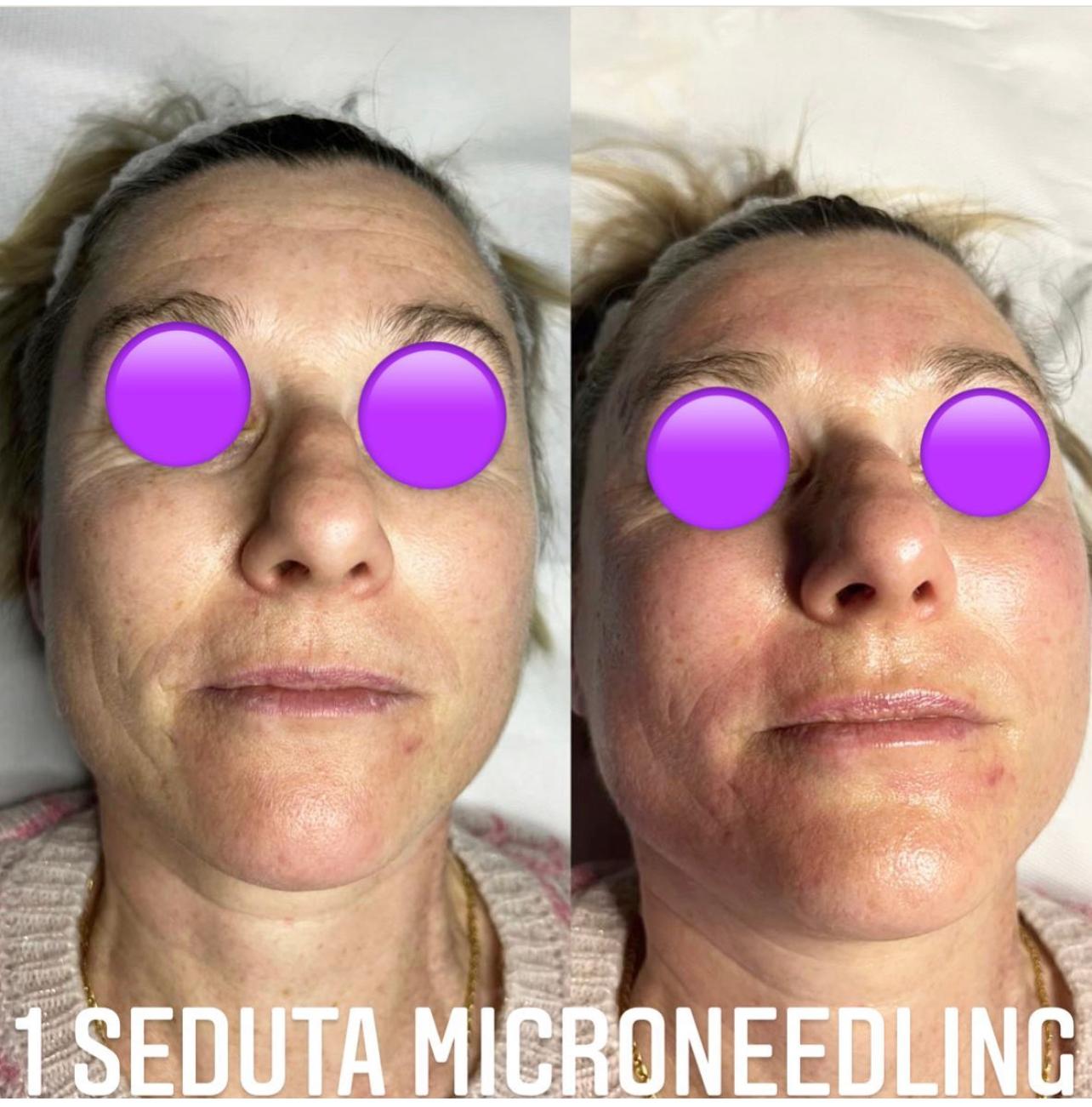 Needling Frame Microneedling - Frame Beauty